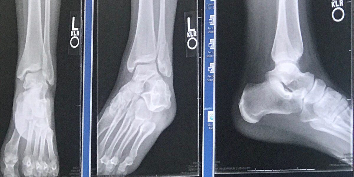 X-rays of a left ankle showing anterior, posterior, and lateral views.